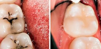 Uradite ovo odmah: SVAKI DAN je koristila OVU smjesu i više nema NITI JEDAN pokvaren zub!