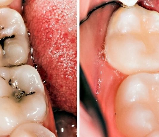 Uradite ovo odmah: SVAKI DAN je koristila OVU smjesu i više nema NITI JEDAN pokvaren zub!