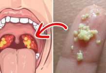 Ovih 6 alarmatnih simptoma na krajnicima ne treba zanemariti