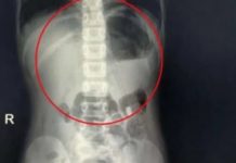 RODITELJI PLAČUĆI DOVELI SINA U BOLNICU, DOKTORI ODMAH URADILI RENDGEN PA DOŽIVJELI VELIKI ŠOK: Pogledajte šta je dijete PROGUTALO, STRAŠNO!