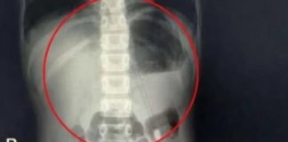 RODITELJI PLAČUĆI DOVELI SINA U BOLNICU, DOKTORI ODMAH URADILI RENDGEN PA DOŽIVJELI VELIKI ŠOK: Pogledajte šta je dijete PROGUTALO, STRAŠNO!