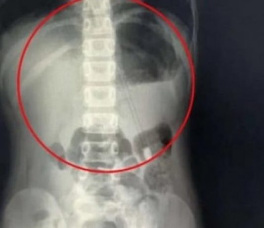 RODITELJI PLAČUĆI DOVELI SINA U BOLNICU, DOKTORI ODMAH URADILI RENDGEN PA DOŽIVJELI VELIKI ŠOK: Pogledajte šta je dijete PROGUTALO, STRAŠNO!